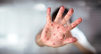 measles rash