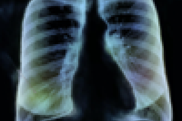 x ray